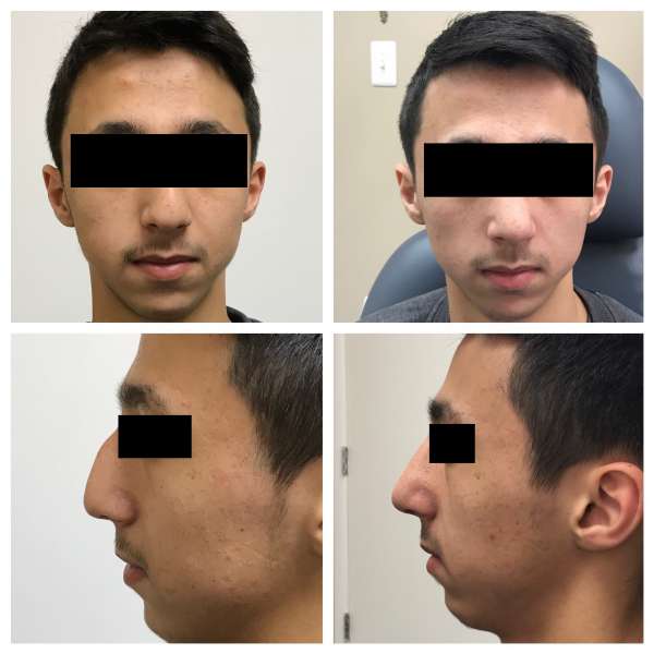 Nose surgery or Rhinoplasty can enhance your self esteem. Contact Dr. Nicholas Bastidas for a consultation on this.