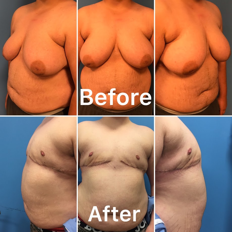 A transgender surgery that we completed in NYC