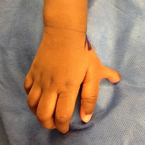 Dr. Bastidas has much experience in surgical reconstruction of extra fingers & toes, resulting in patient satisfaction.