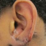 Ear Reconstruction Postoperative