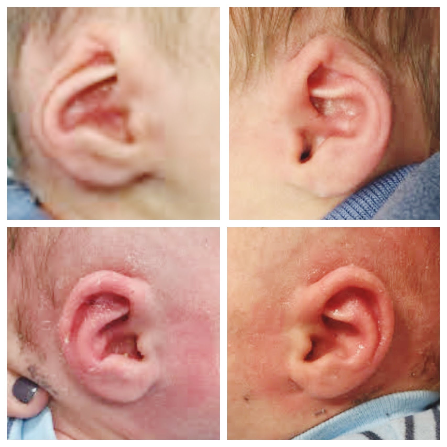 Ear molding is a non-surgical correction for congenital ear deformities in infants to restore normal ear anatomy.