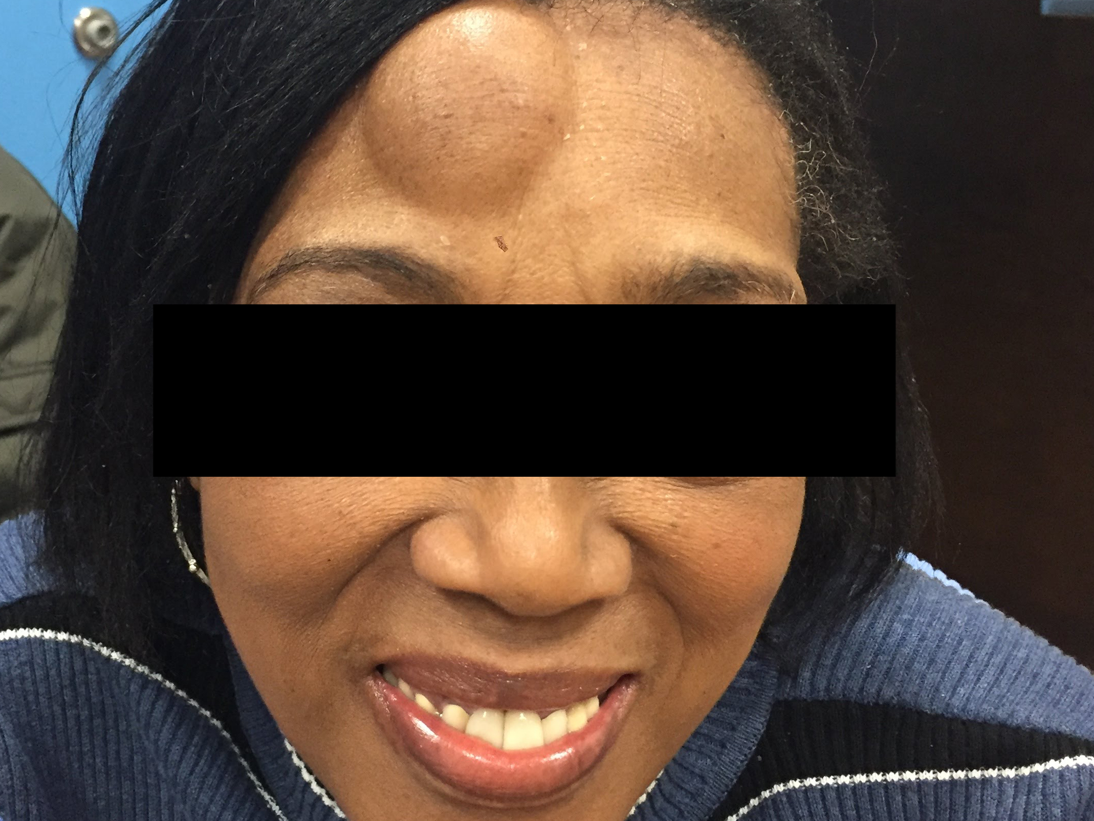 A woman before lipoma surgery near Long Island