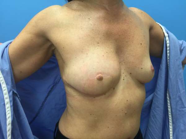 Dr. Nicholas Bastidas has extensive experience in performing the variety of breast reconstructive surgeries available.