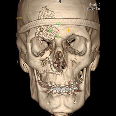 A computer image of a face that needs craniofacial surgery in NYC
