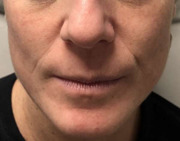 Dr. Nicholas Bastidas has a busy practice using fillers for non-surgical treatments for a range of cosmetic enhancements.