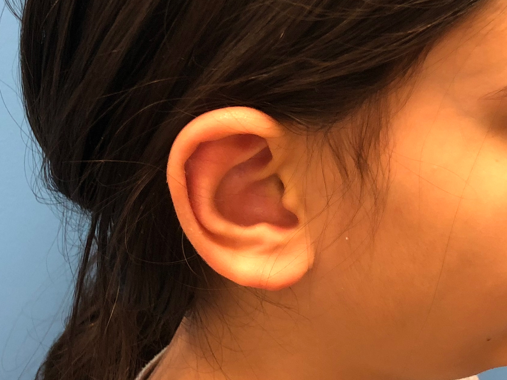 Ear Reduction