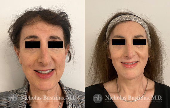 Jaw Reduction in Facial Feminization Surgery for Transwomen