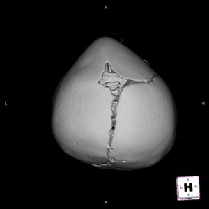 With resorbable plates, screws and sutures, abnormal bones are contoured and repositioned to recreate normal anatomy.