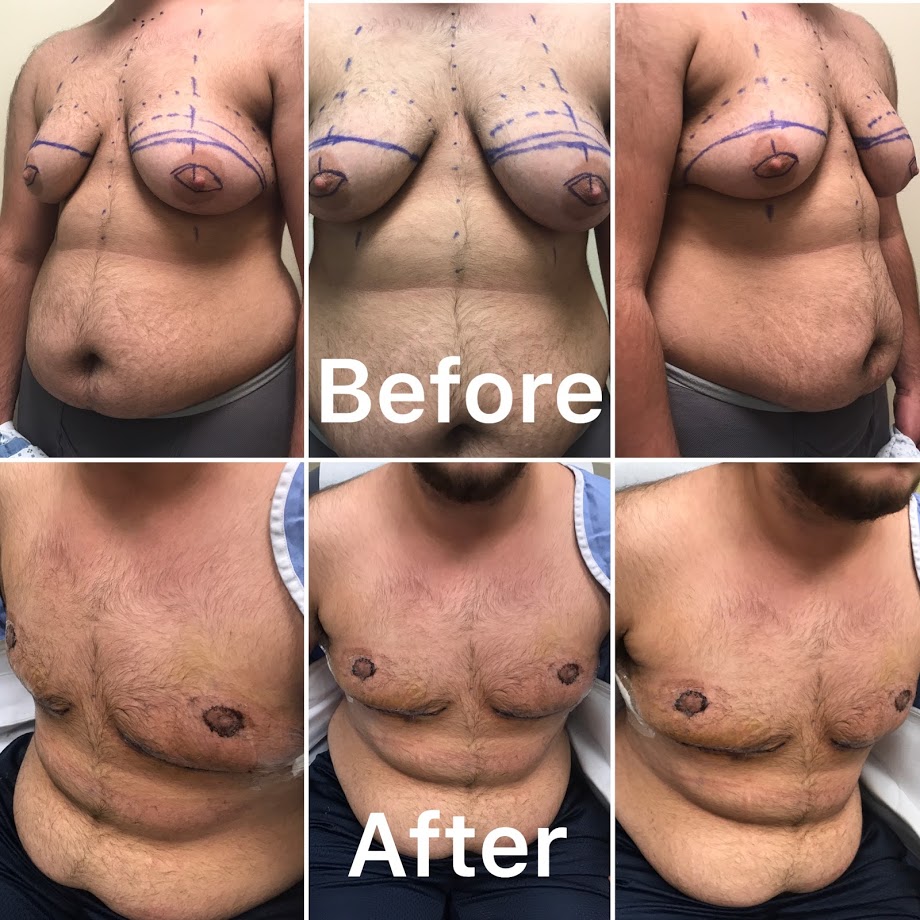 Transgender female to male breast surgery