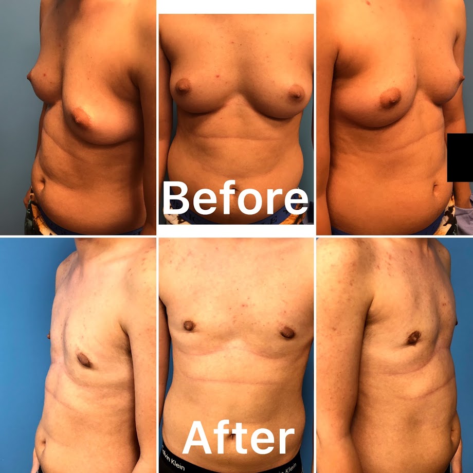 Transgender female to male breast surgery