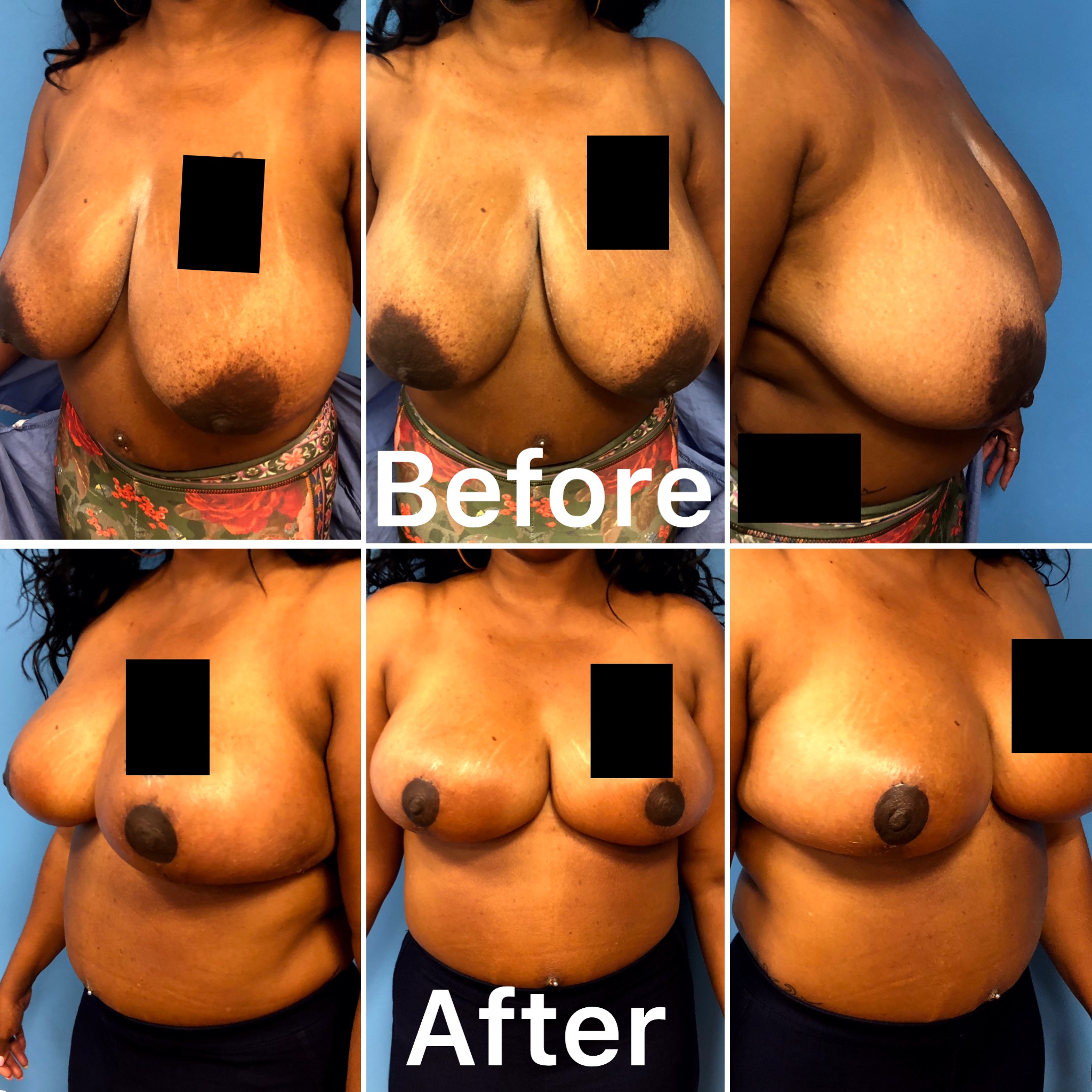 Dr. Bastidas performs breast reduction surgery on men and women and youth with over-developed breasts.