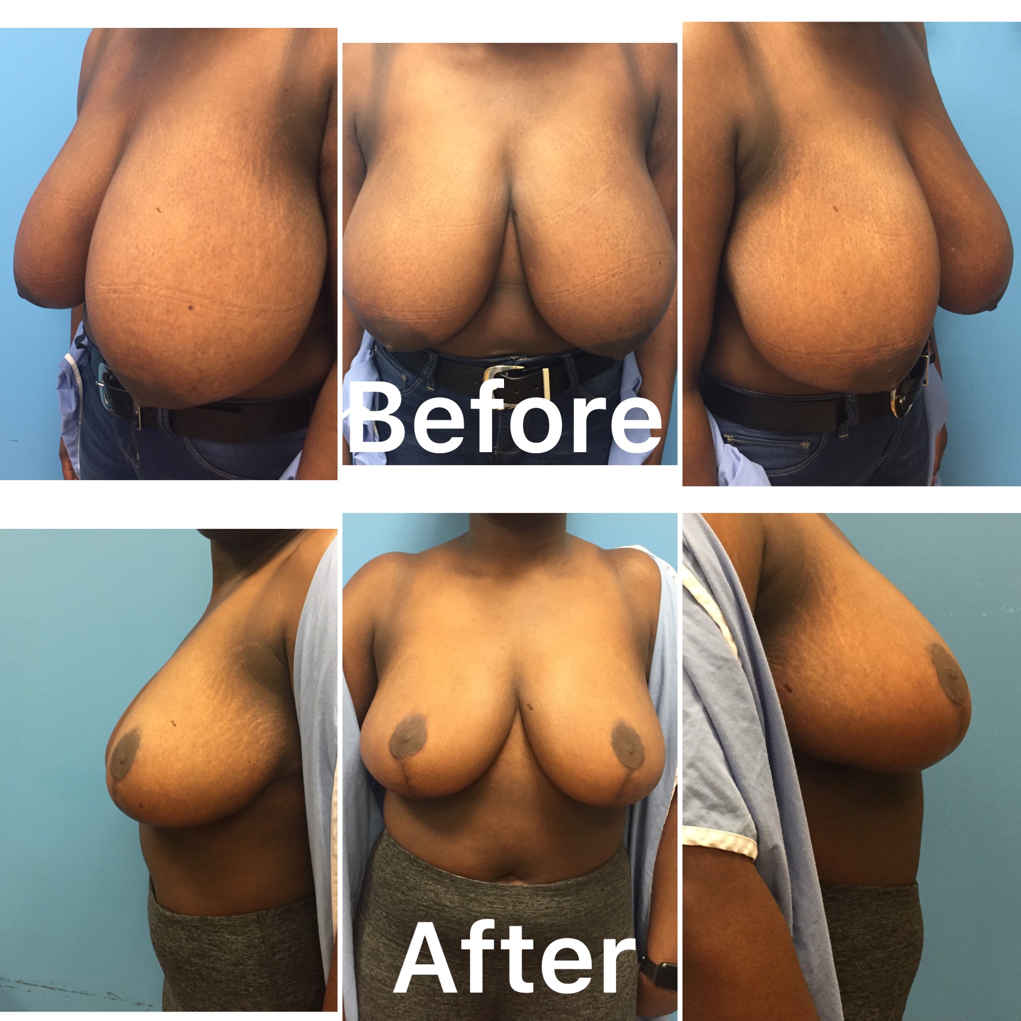 Dr. Bastidas performs breast reduction surgery on men and women and youth with over-developed breasts.