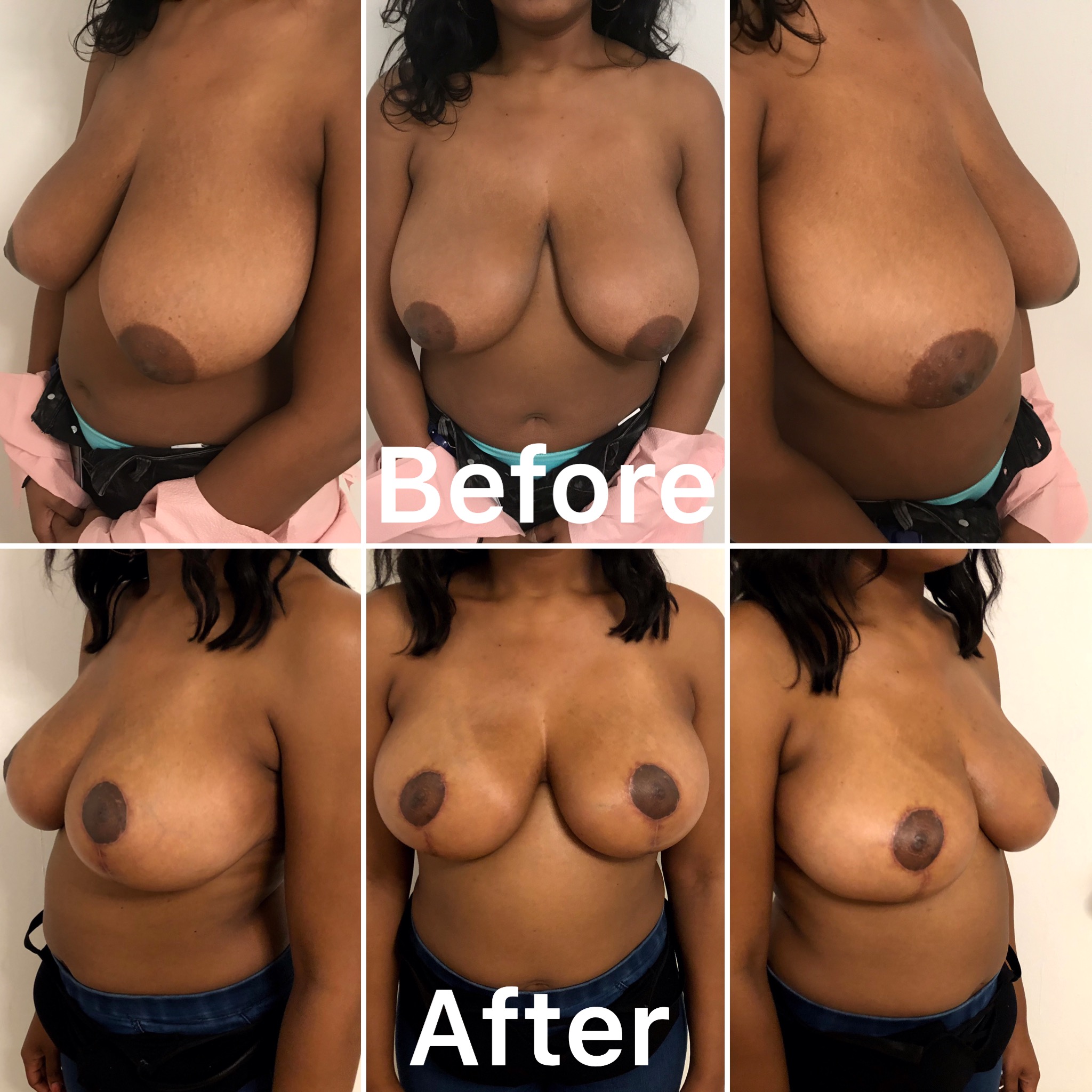 Dr. Bastidas performs breast reduction surgery on men and women and youth with over-developed breasts.