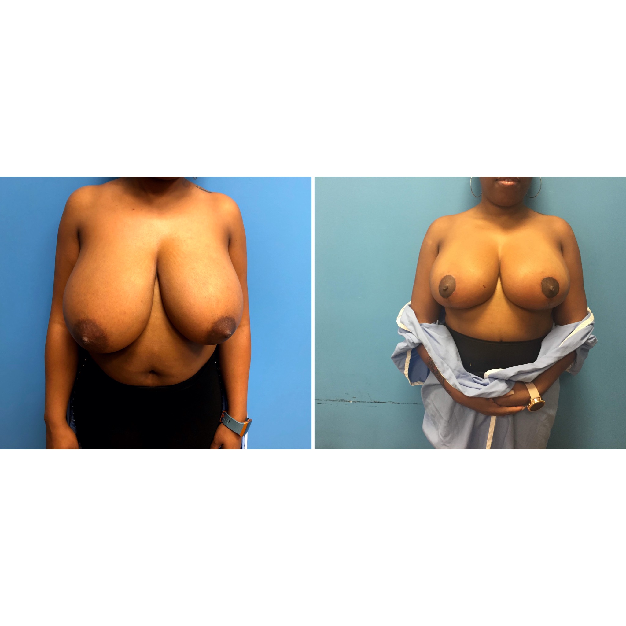 Dr. Bastidas performs breast reduction surgery on men and women and youth with over-developed breasts.