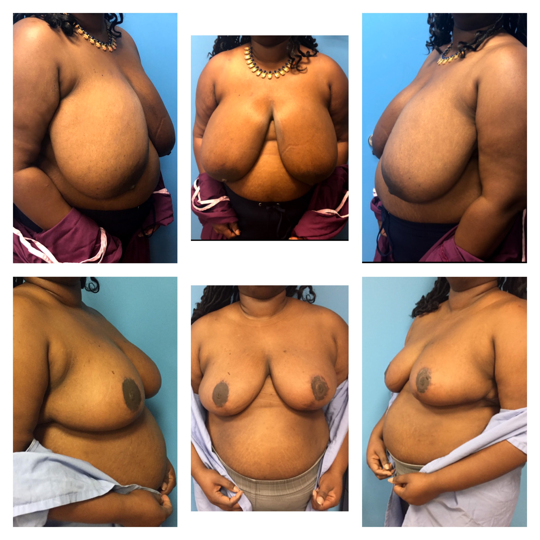 Dr. Bastidas performs breast reduction surgery on men and women and youth with over-developed breasts.