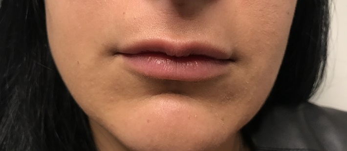 Dr. Bastidas is well known in New York & Long Island for lip augmentation, receiving referrals from satisfied patients.