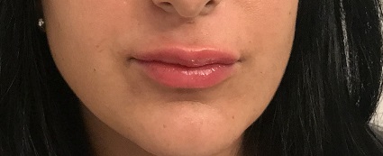 Dr. Bastidas is well known in New York & Long Island for lip augmentation, receiving referrals from satisfied patients.