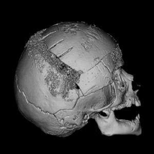 With resorbable plates, screws and sutures, abnormal bones are contoured and repositioned to recreate normal anatomy.