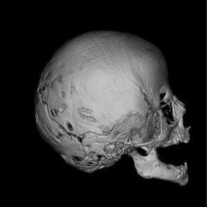 With resorbable plates, screws and sutures, abnormal bones are contoured and repositioned to recreate normal anatomy.