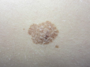 A congenital nevus is present at birth and carries a higher rate of possible conversion to the cancer melanoma.