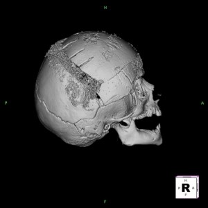 Dr. Bastidas performs pediatric craniosynostosis & craniofacial plastic surgery with offices in New York & Long Island.