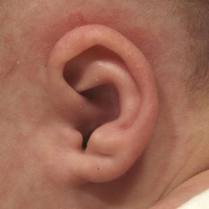 Ear molding is a non-surgical correction for congenital ear deformities in infants to restore normal ear anatomy.