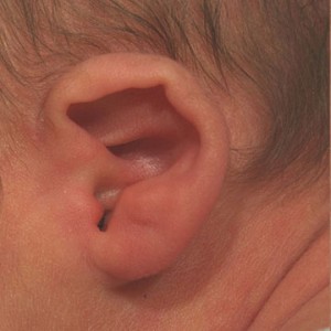 Ear molding is a non-surgical correction for congenital ear deformities in infants to restore normal ear anatomy.