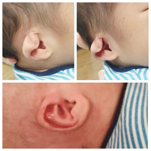 Ear molding is a non-surgical correction for congenital ear deformities in infants to restore normal ear anatomy.