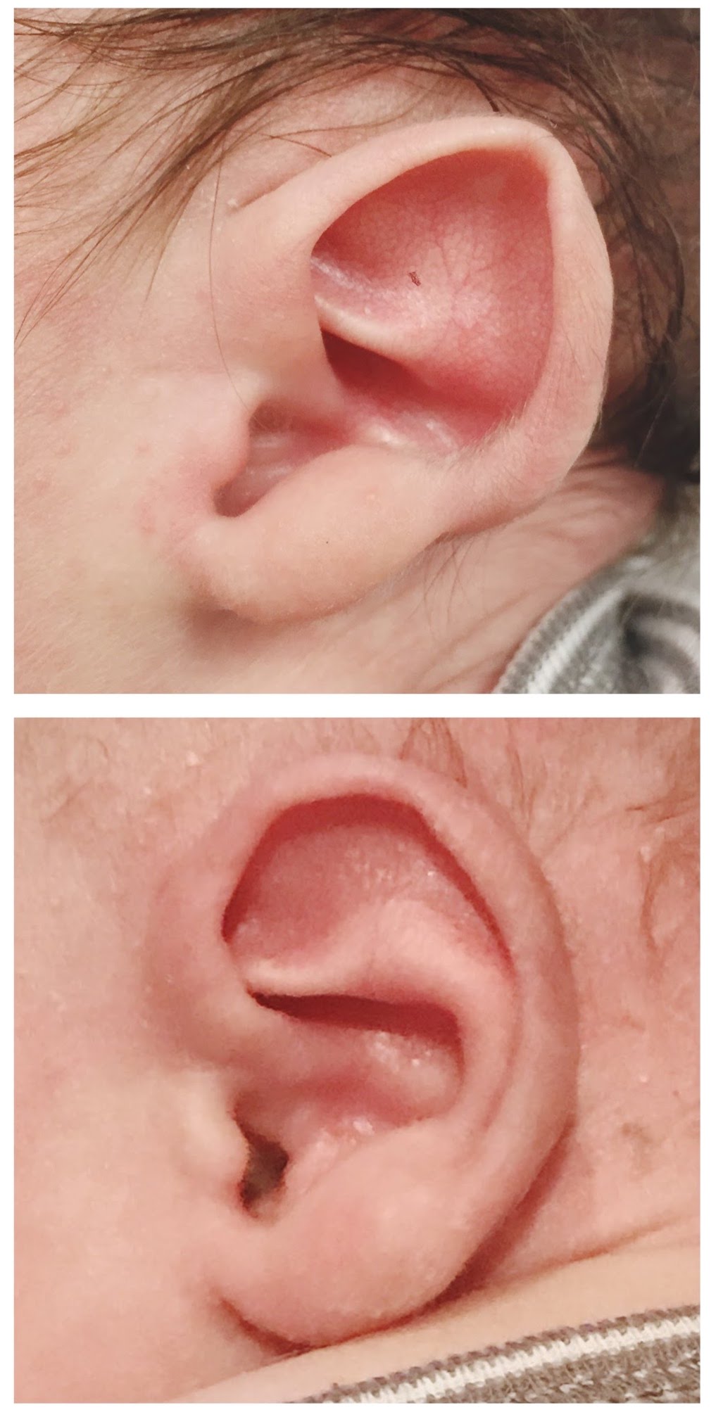 Ears before and after having ear molding in NYC