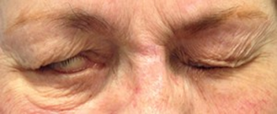 Dr. Bastidas treats many facial paralysis conditions including raising & tightening the lower lid for less eye exposure.