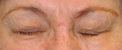 Dr. Bastidas treats many facial paralysis conditions including raising & tightening the lower lid for less eye exposure.