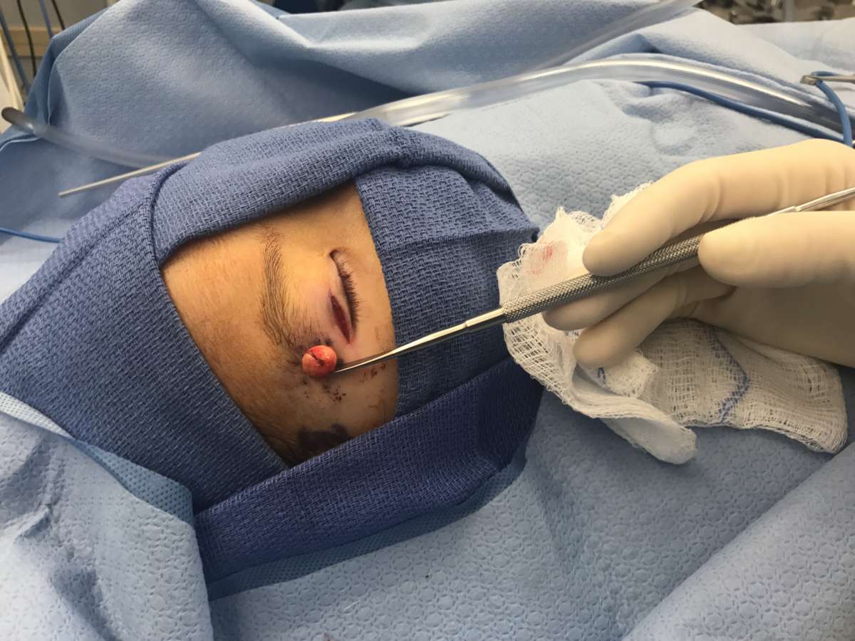 A dermoid cyst surgery being done on a child in NYC