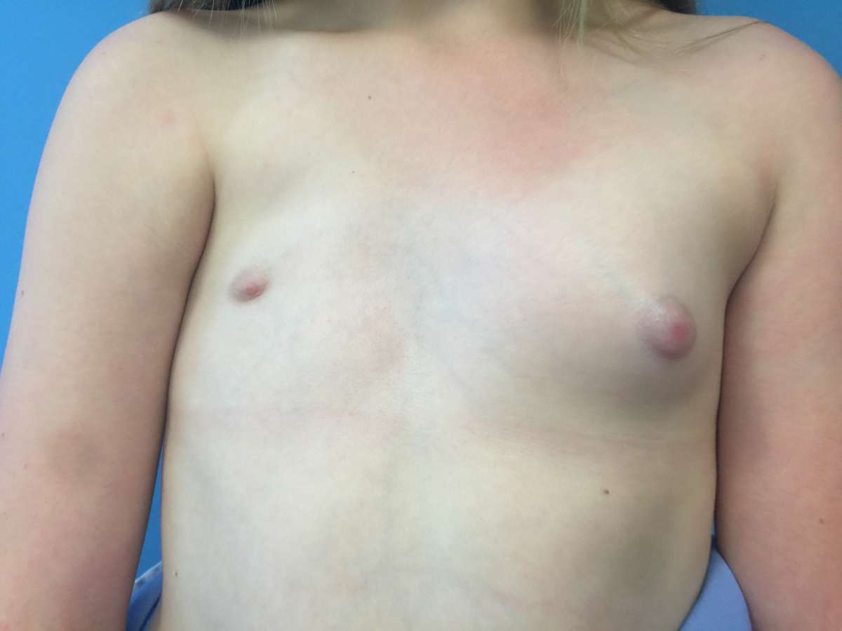 Poland Syndrome and Tuberous Breasts can be treated with surgery and may involve placement of a breast implant.