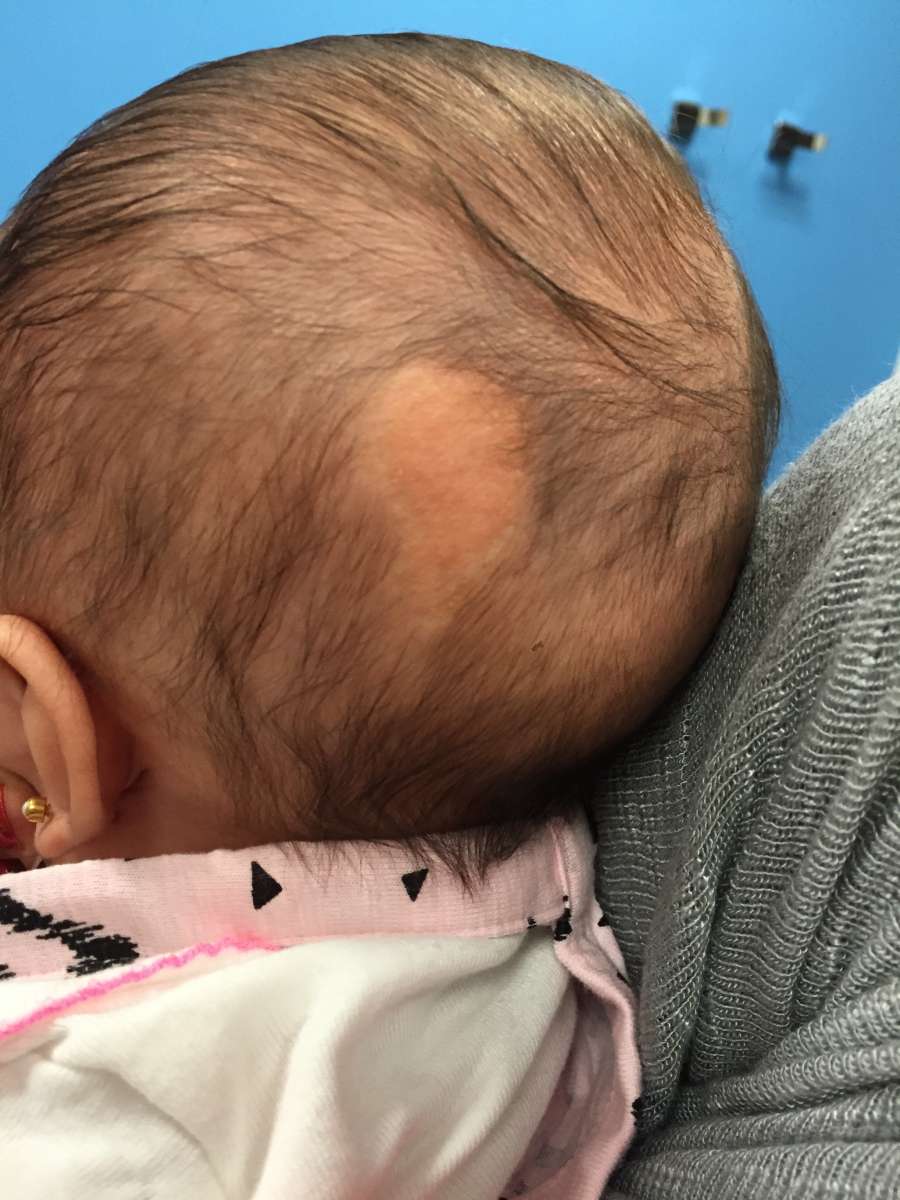 Nevus sebaceous birthmarks, found on the scalp of newborns, have a risk of becoming a skin cancer and should be removed.