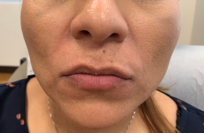 Dr. Bastidas is well known in New York & Long Island for lip augmentation, receiving referrals from satisfied patients.