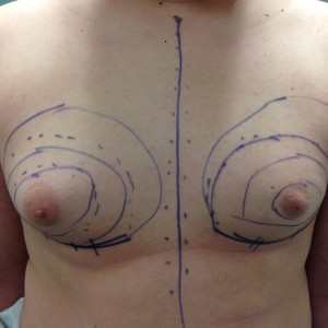 Male breast enlargement may occur soon after puberty as a result of the imbalance of estrogen and testosterone.