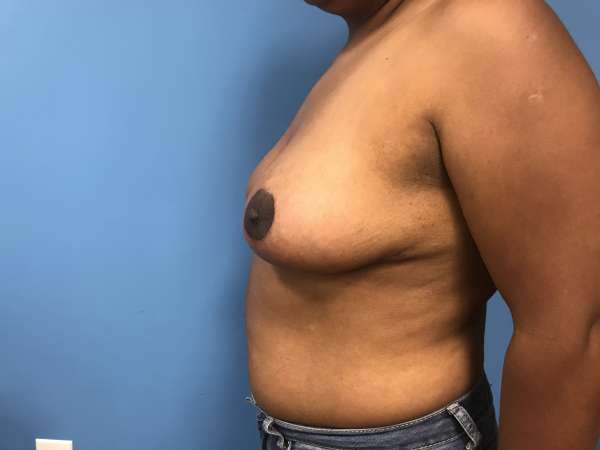 Dr. Bastidas performs breast reduction surgery on men and women and youth with over-developed breasts.