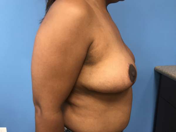 Dr. Bastidas performs breast reduction surgery on men and women and youth with over-developed breasts.