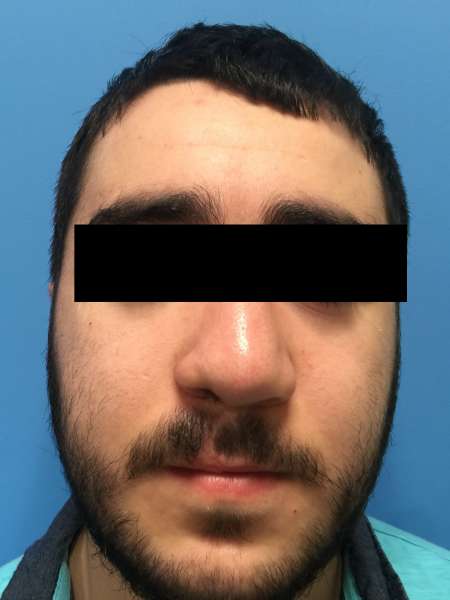Dr. Nicholas Bastidas performs cleft rhinoplasty on patients to correct deviated septum, the rim & the tip of the nose.