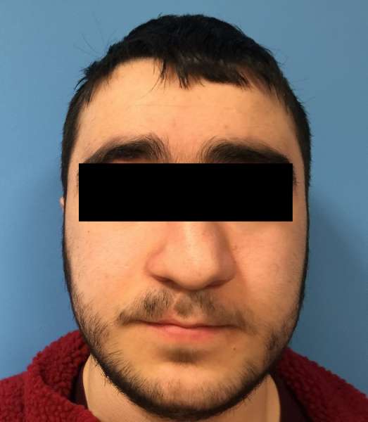 Dr. Nicholas Bastidas performs cleft rhinoplasty on patients to correct deviated septum, the rim & the tip of the nose.