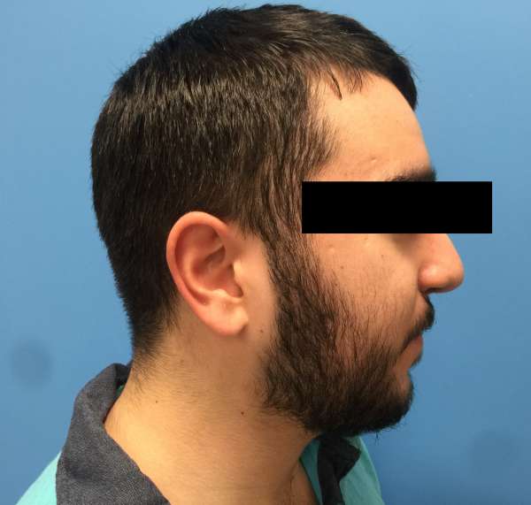 Dr. Nicholas Bastidas performs cleft rhinoplasty on patients to correct deviated septum, the rim & the tip of the nose.