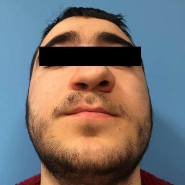 Dr. Nicholas Bastidas performs cleft rhinoplasty on patients to correct deviated septum, the rim & the tip of the nose.