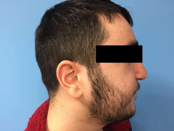 Dr. Nicholas Bastidas performs cleft rhinoplasty on patients to correct deviated septum, the rim & the tip of the nose.