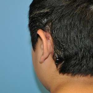 Dr. Nicholas Bastidas has an excellent reputation for adult and child reconstructive plastic surgery for ears.