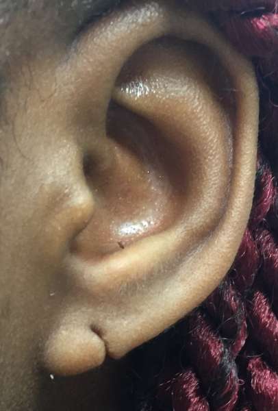 md earlobe