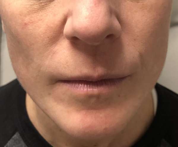 Dr. Nicholas Bastidas has a busy practice using fillers for non-surgical treatments for a range of cosmetic enhancements.