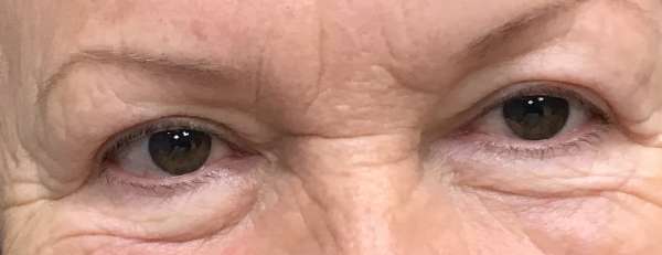 Upper eyelid surgery can be performed in the office while you rest under local anesthesia. Scars are well hidden.