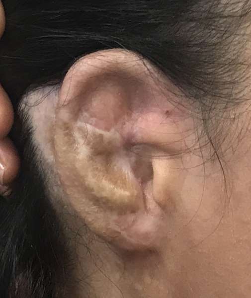 Dr. Nicholas Bastidas has an excellent reputation for adult and child reconstructive plastic surgery for ears.