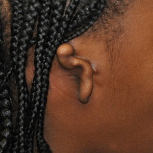 Dr. Bastidas' commitment to pediatric correction of deformities places your child in great hands for microtia surgery.