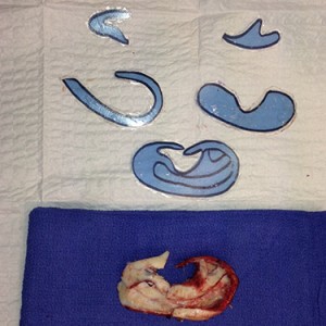 Dr. Bastidas' commitment to pediatric correction of deformities places your child in great hands for microtia surgery.